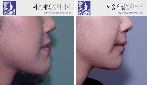 ASO instead of two-jaw surgery before and after profile, Korea