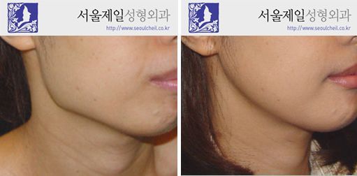 Square jaw reduction before and after jawline, Seoul
