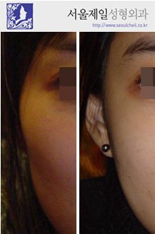 Cheekbone reduction before and after side view, Seoul