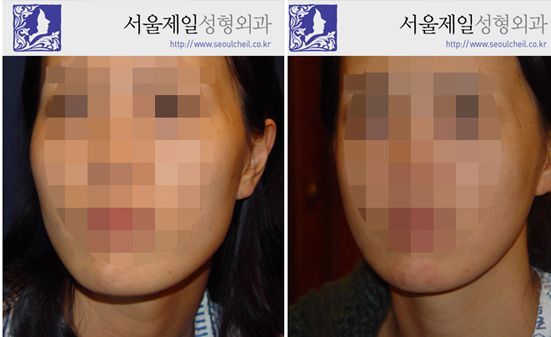 V-line surgery before and after front view, Seoul
