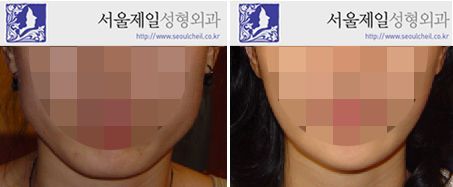 V-line jaw surgery before and after lower face, Korea