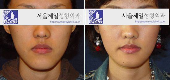 Long face correction before and after front view, Seoul