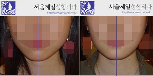 Facial asymmetry correction before and after front view, Seoul Cheil Plastic Surgery