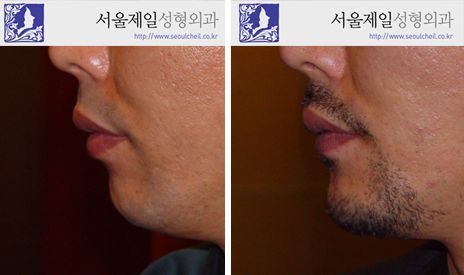 Genioplasty chin surgery before and after profile, Seoul