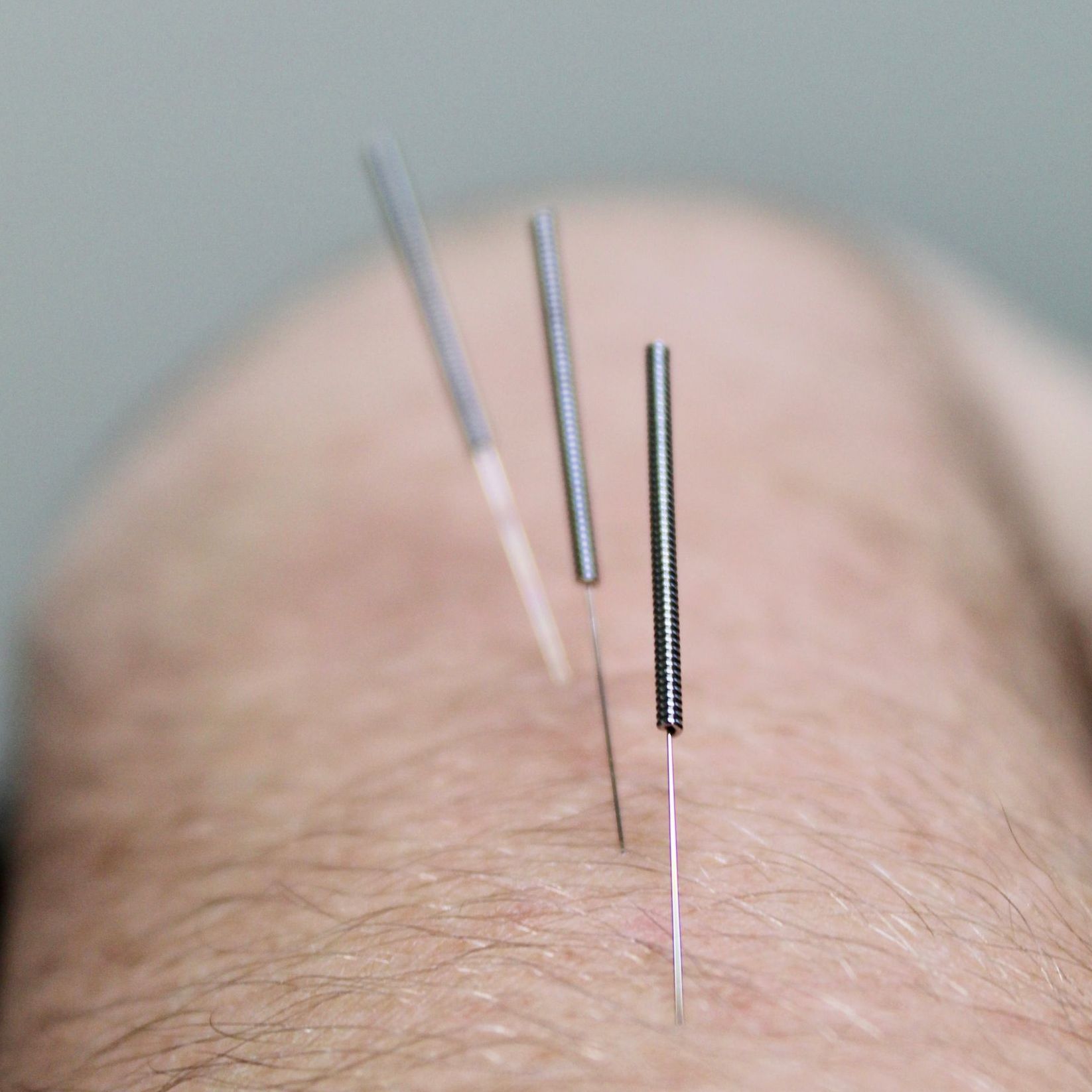 Dry needling Dry needling