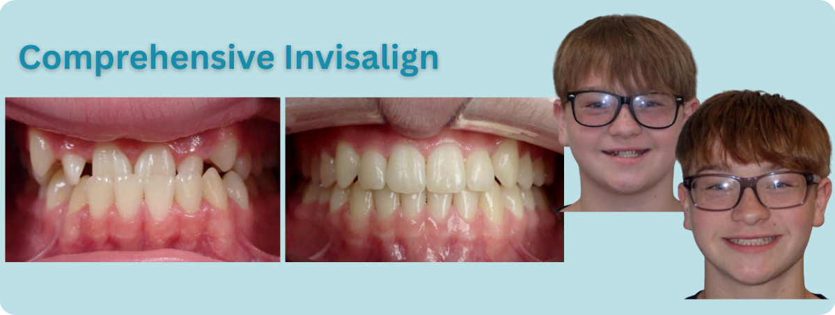 “Comprehensive Invisalign” graphic with three mouth photos and two smiling portraits of a boy with glasses.
