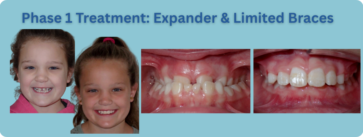 Phase 1 treatment: child before and after braces, with close-up teeth photos