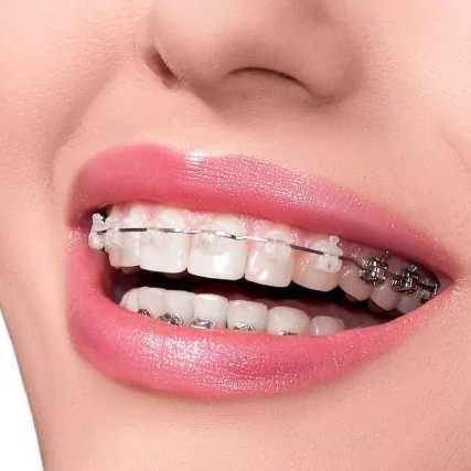 Ceramic Braces