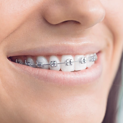 Metal Braces