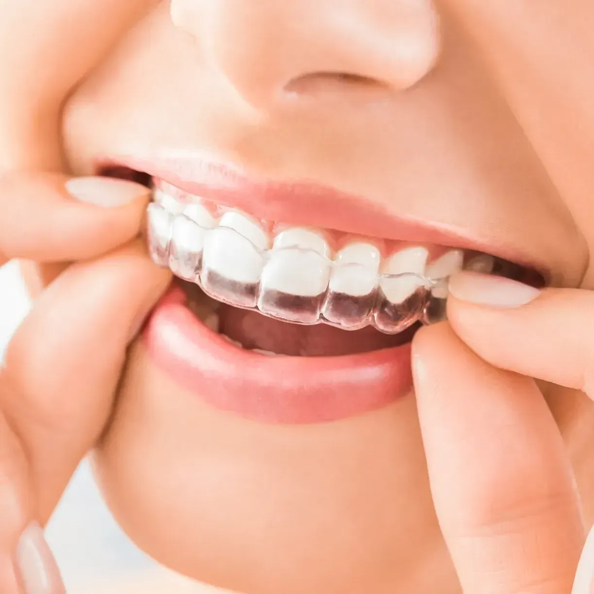 Invisalign