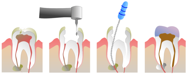 schema della terapia canalare 