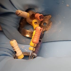 Link per saperne di più sulla Endodonzia: Si vede un dente isolato dalla bocca con la diga di gomma nelle prime fasi della devitalizzazione (erroneamente chiamata anche devilizzazione o vitalizzazione).