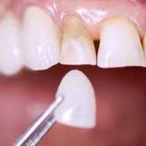 Faccette, faccetta, odontoiatria estetica, sbiancamento, bleaching, estetica dentale, lumineers, disilicato, zirconia, corone, corona