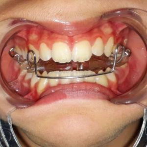 ortodonzia mobile, ortodonzia rimovibile, ortodonzia bambini, logopedia, puntamento linguale, deglutizione atipica, dislalia, dentista afragola, dentista afragola Fico