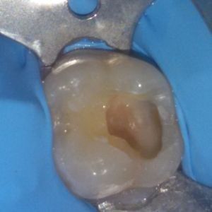 Carie caria otturazione piombatura di dente cura di dente ammalato diga di gomma