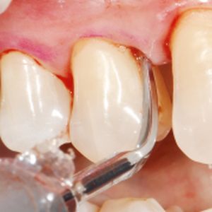 pulizia dei denti