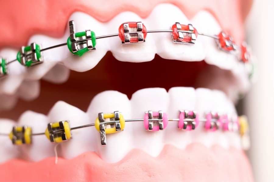 brackets in acciaio 