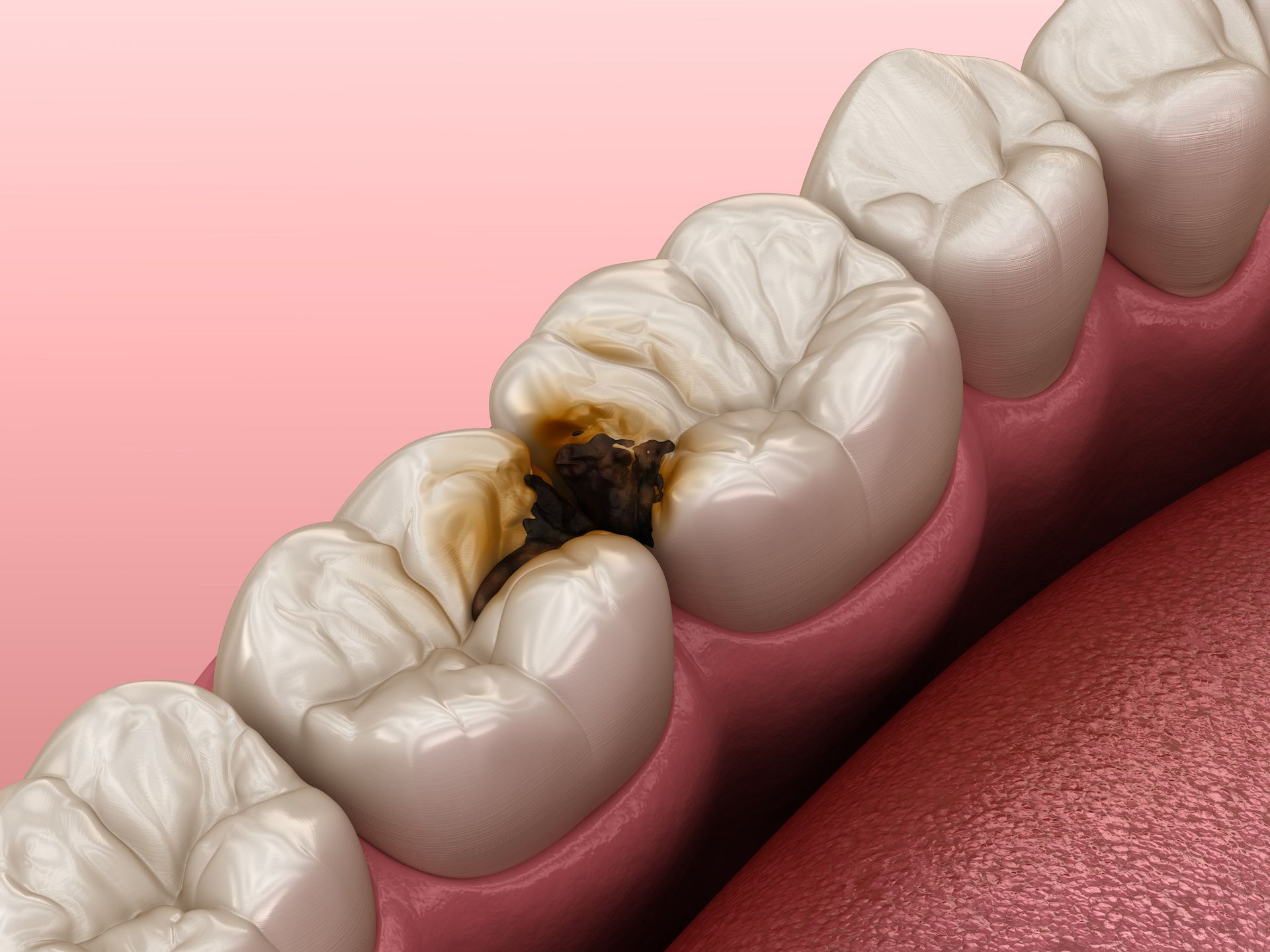 Dente ammalato 