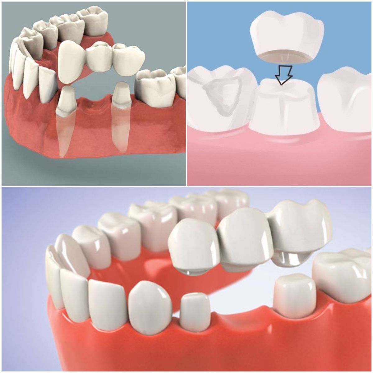 Ponte; rimettere un dente