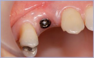 guarigione di un impianto dentale 