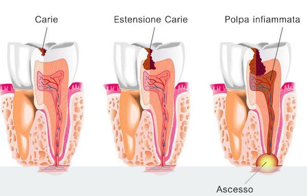 Immagine che descrive la struttura del dente, come viene danneggiata dalla carie e cosa accade quanto arriva alla parte viva