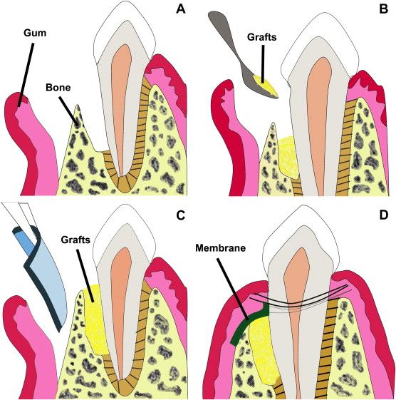 esempio di chirurgia rigenerativa della gengiva 