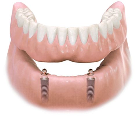 Protesi Rimovibile su impianti; dentiera su impianti; 