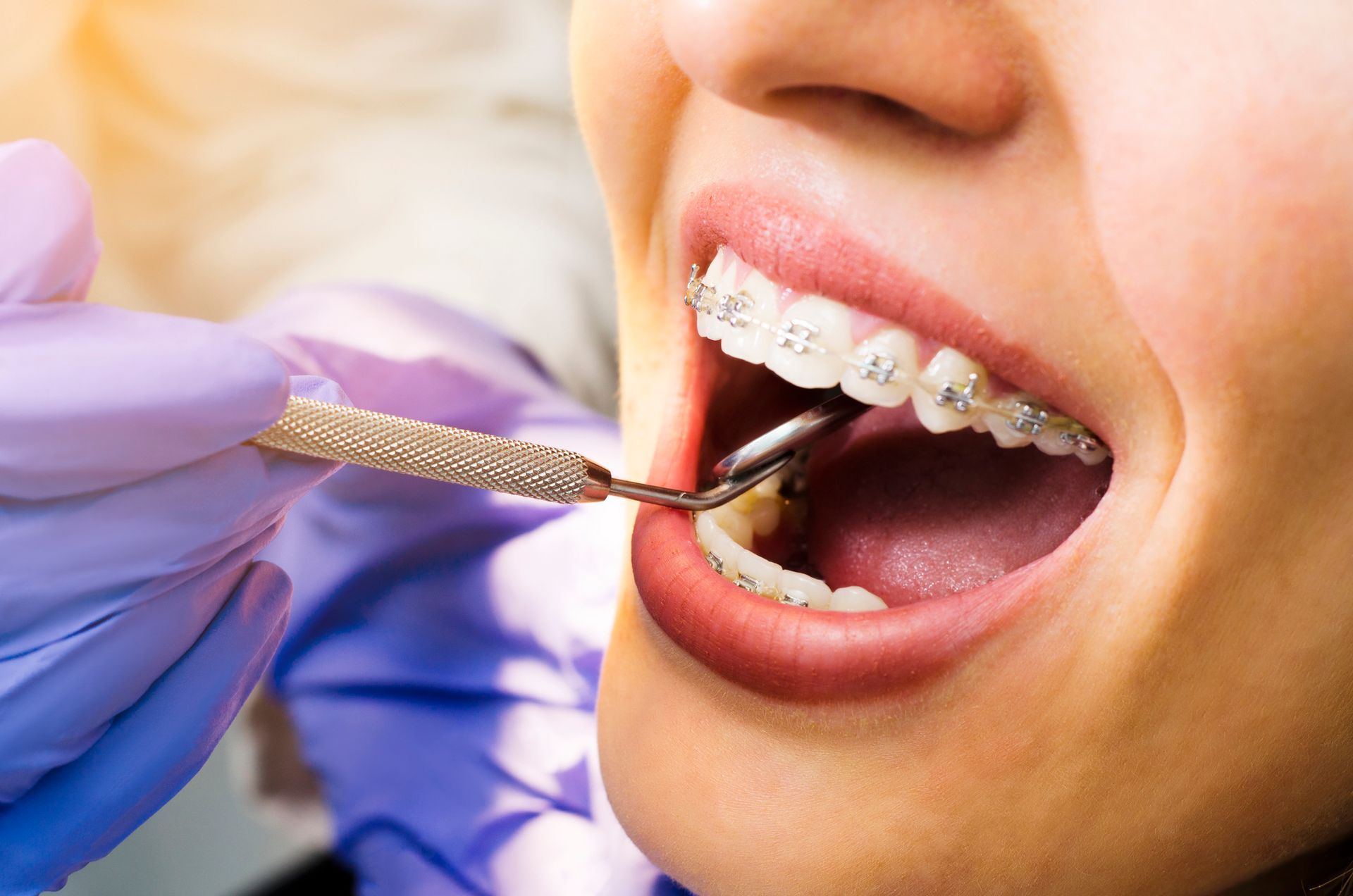 Person with braces has mouth open; dental tool in use.