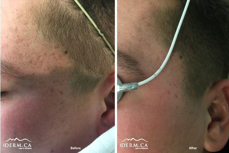 PicoSure Laser for Acne Scars Calgary, AB Derm.ca