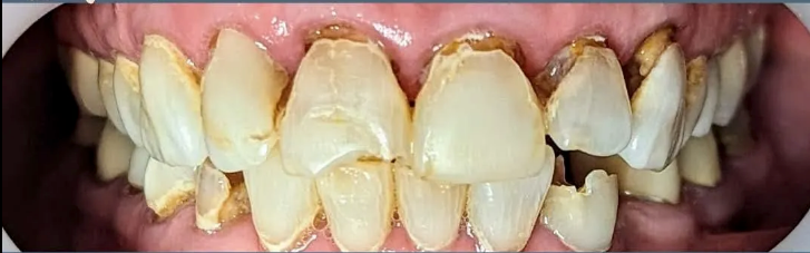 A close up of a person 's teeth with a lot of plaque on them.