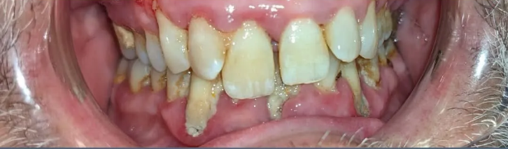 A close up of a person 's teeth with a lot of plaque on them.