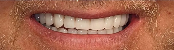 A close up of a man 's teeth with a beard.