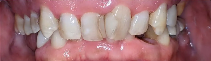 A close up of a person 's teeth with a missing tooth.