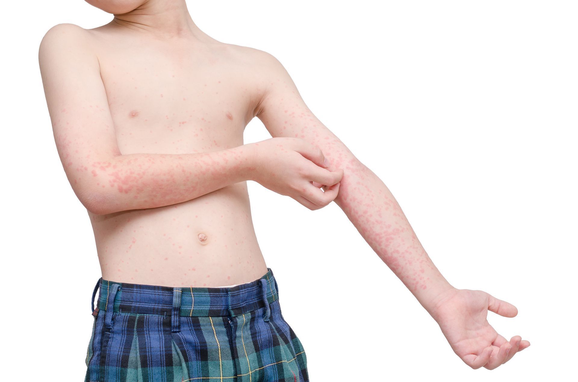  DR. MANUEL ROUSSE NURICUMBO - Urticaria
