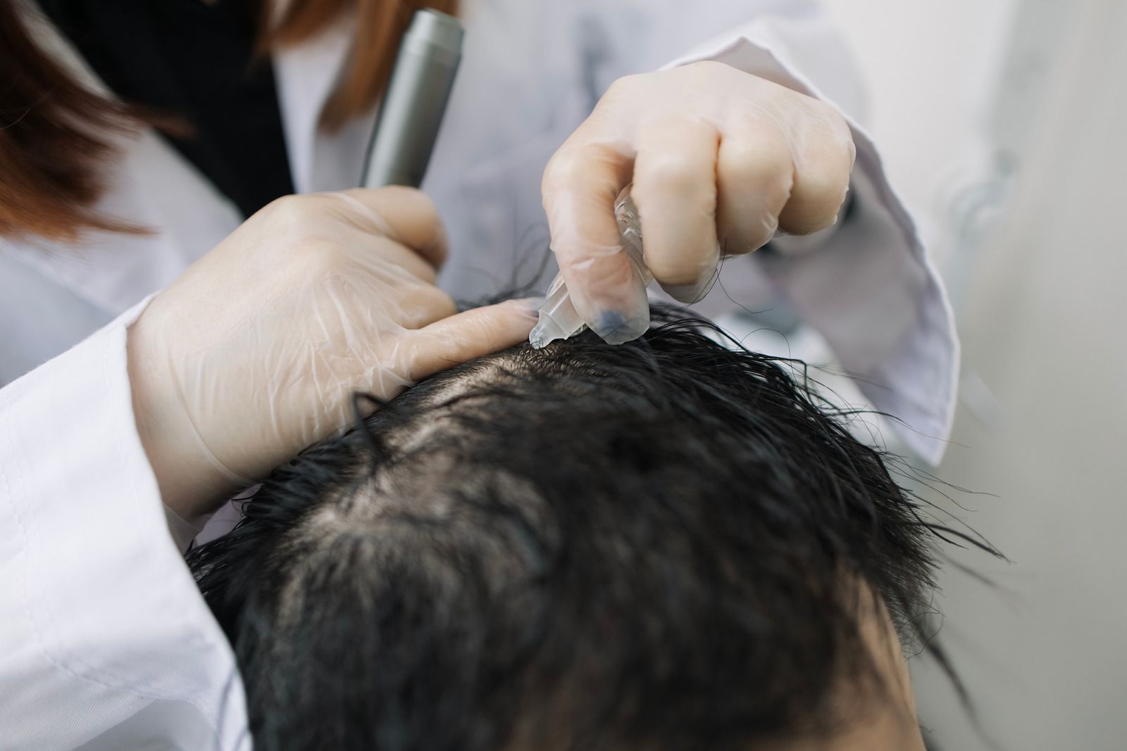 Hands in gloves performing a hair transplant on a balding scalp, in a clinic setting.