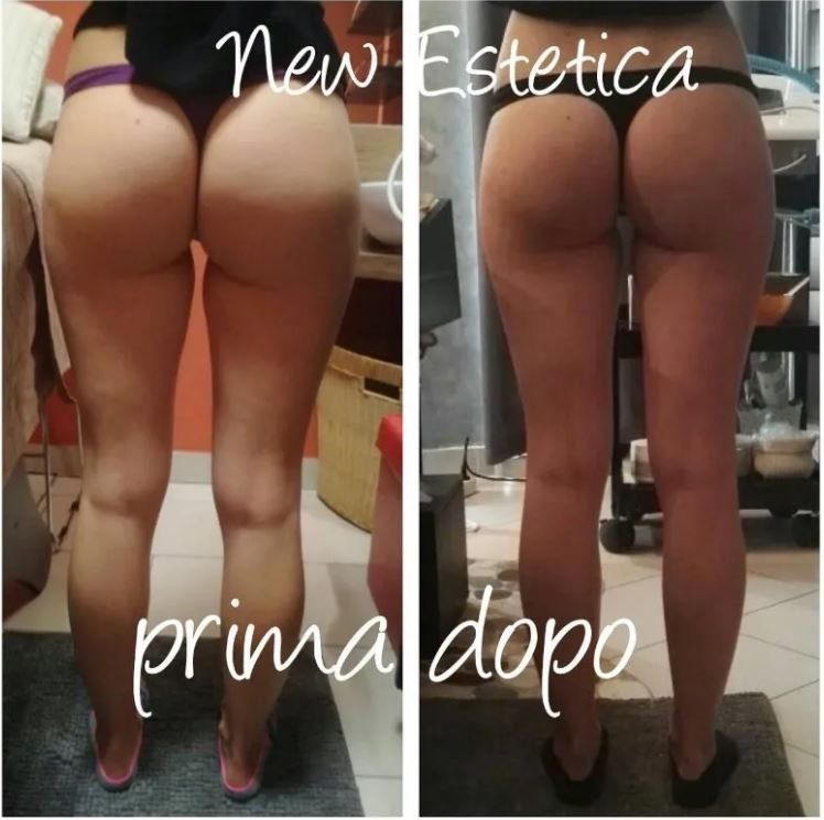 Confronto prima e dopo di glutei e gambe che mostra i risultati di un trattamento estetico, etichettati 