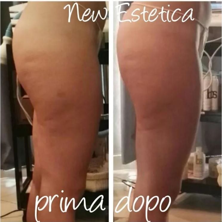 Confronto della parte superiore della coscia di una persona, che mostra la pelle prima e dopo un trattamento cosmetico.