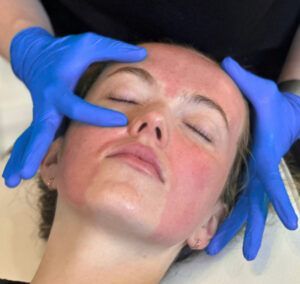Woman with red skin undergoing facial treatment; gloved hands on either side of her face.