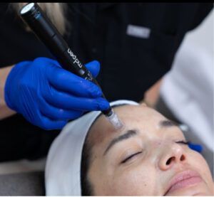 A person receiving microneedling treatment on their forehead. A gloved hand holds a black pen-like device.