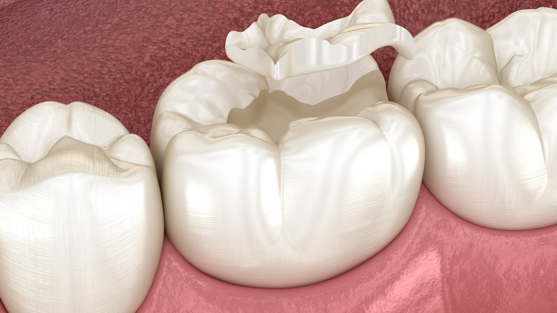 dental sealant procedure