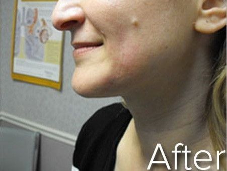 Woman's profile showing a smooth jawline and neck, with 