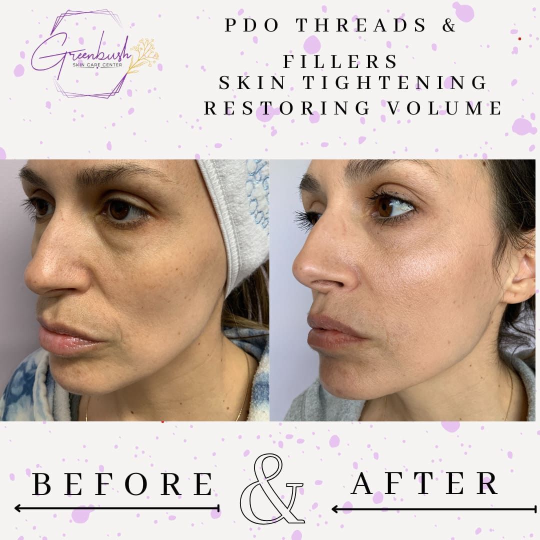 Before & After 14