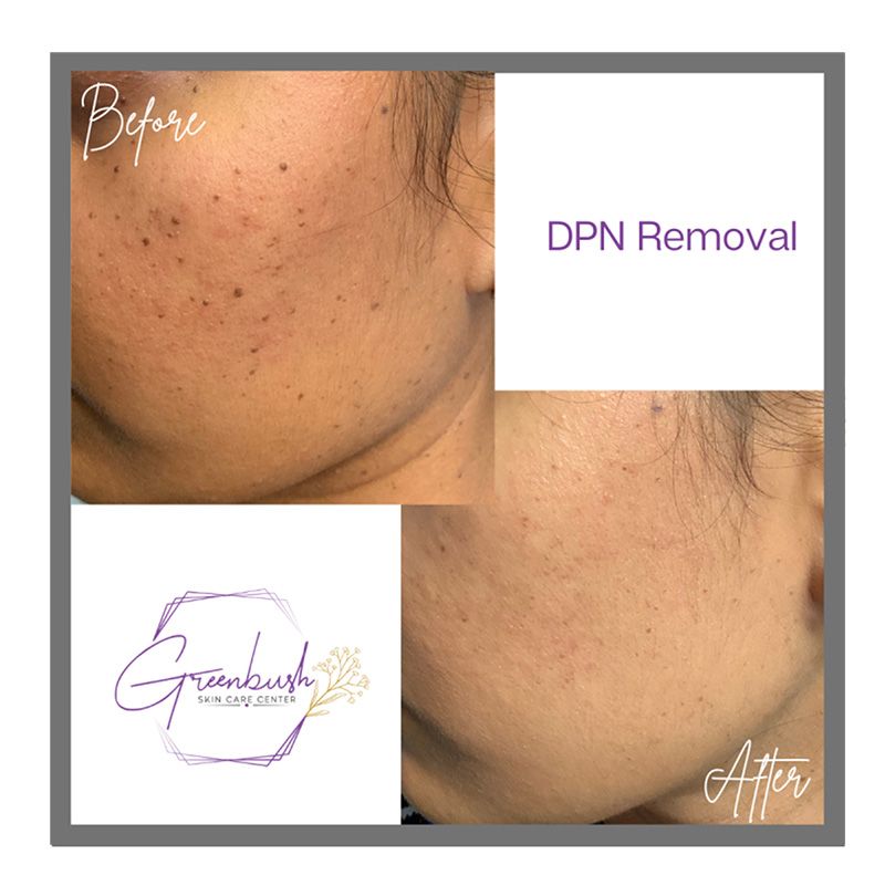 DPN Treatment 2
