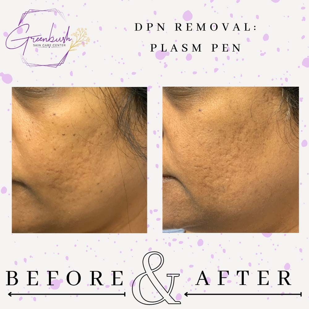 DPN Treatment 3