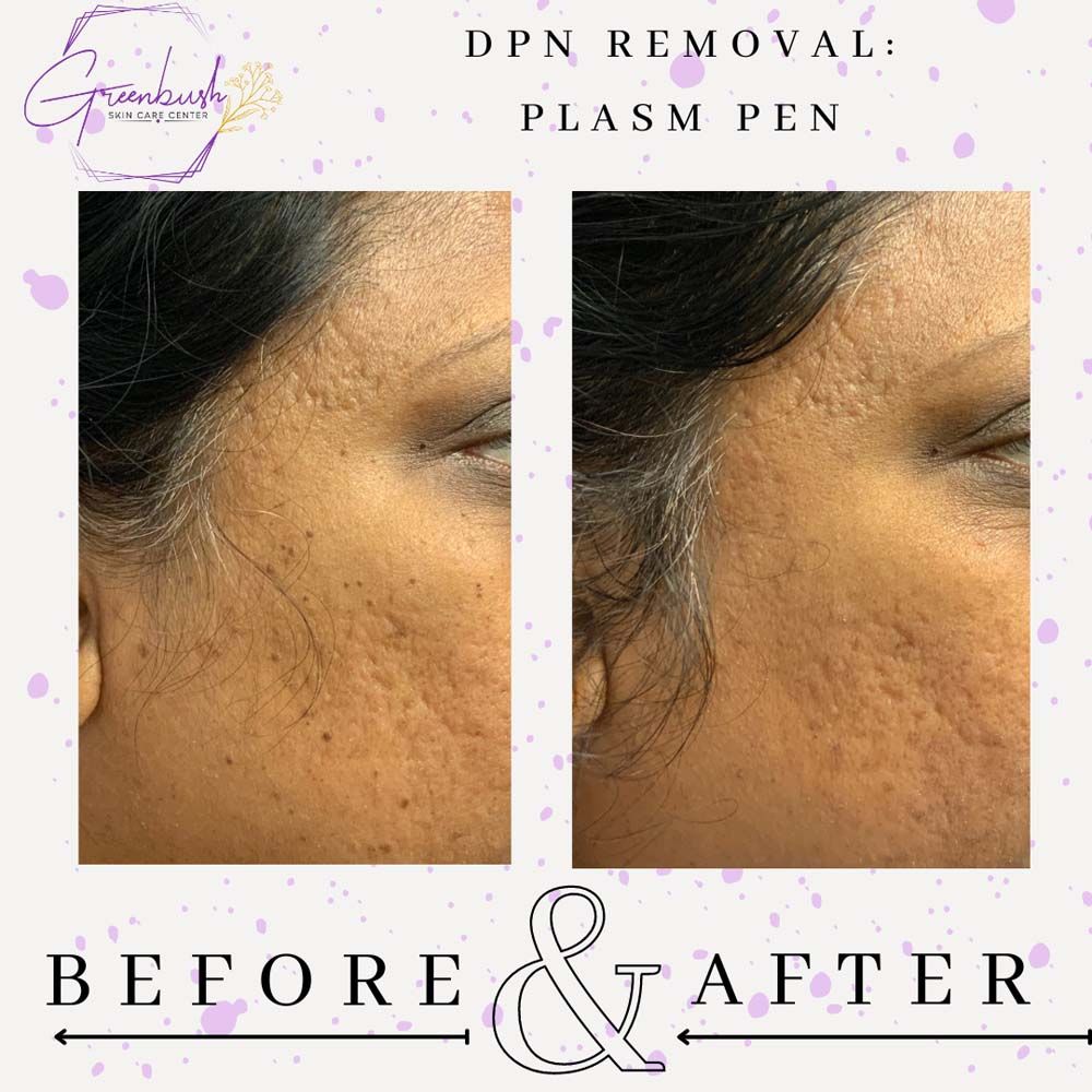 DPN Treatment 4