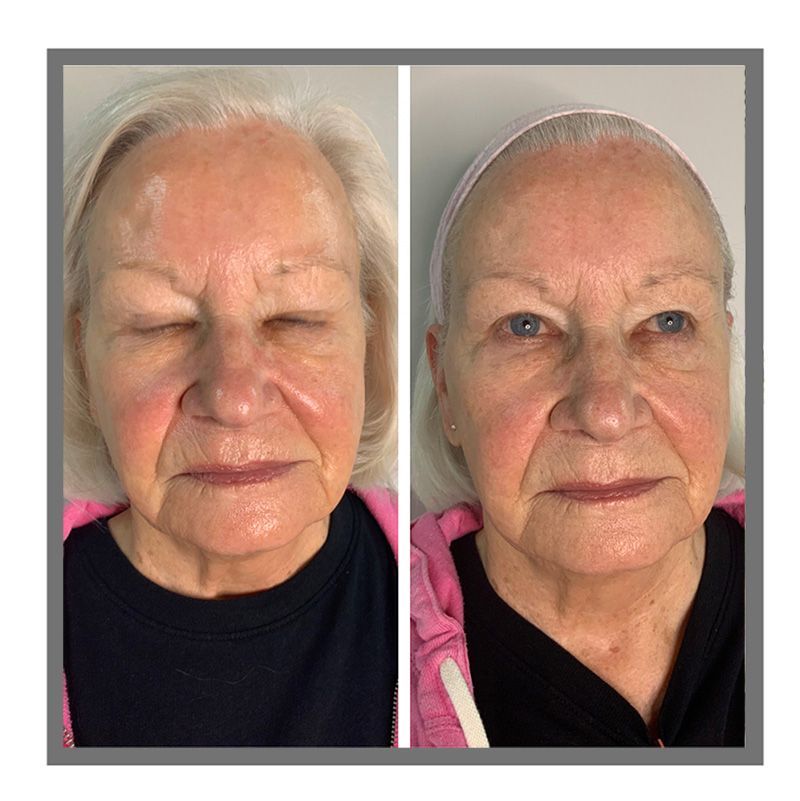 Hydrafacial 1