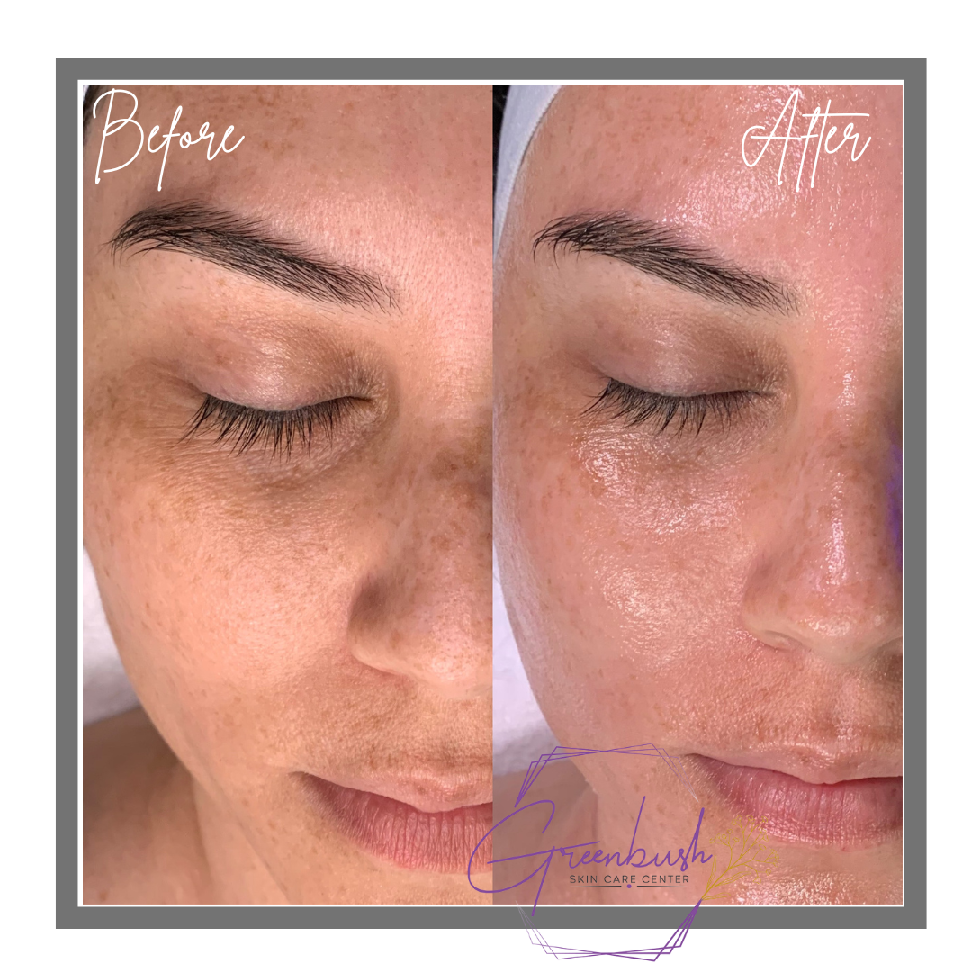 Hydrafacial 2