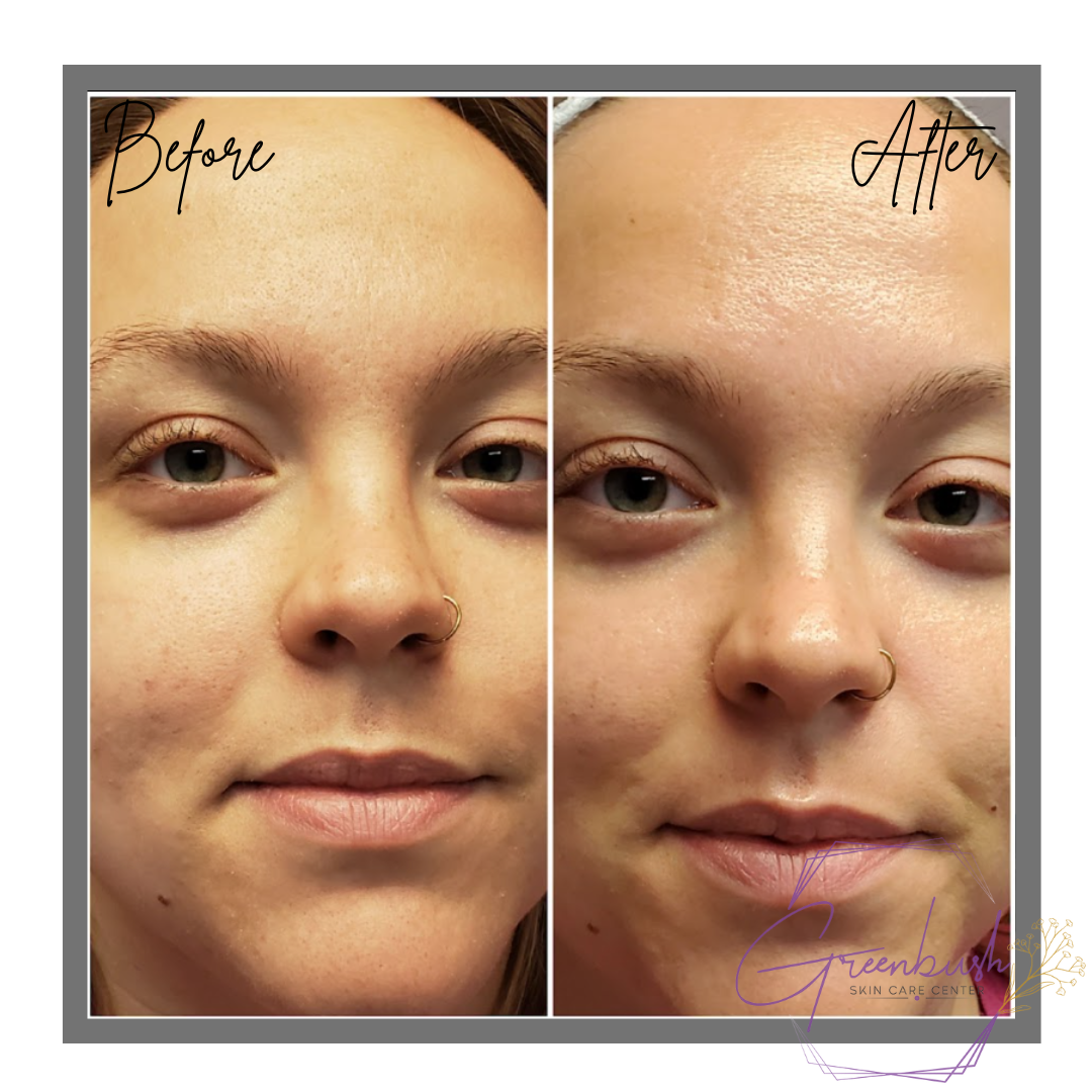 Hydrafacial 3