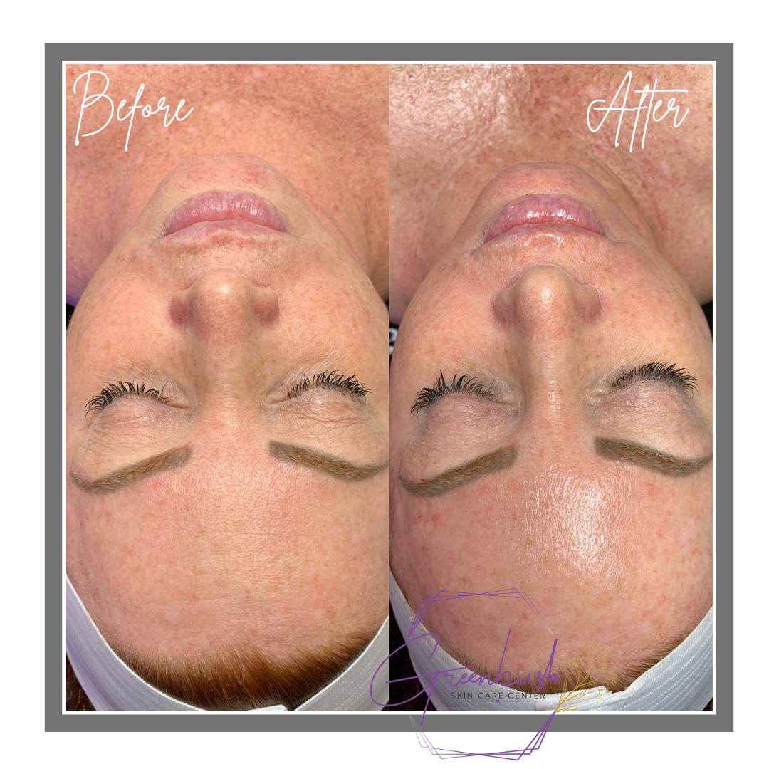 Hydrafacial 4