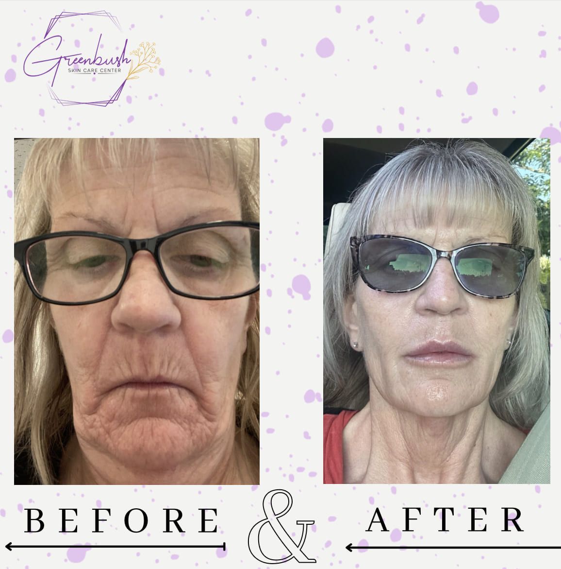 Before & After 40